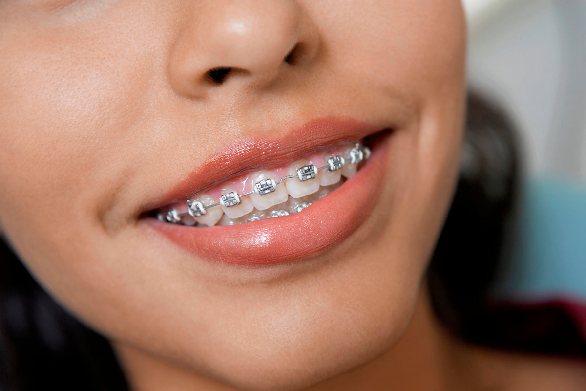 Fixed braces: What to expect and how to take care of them
