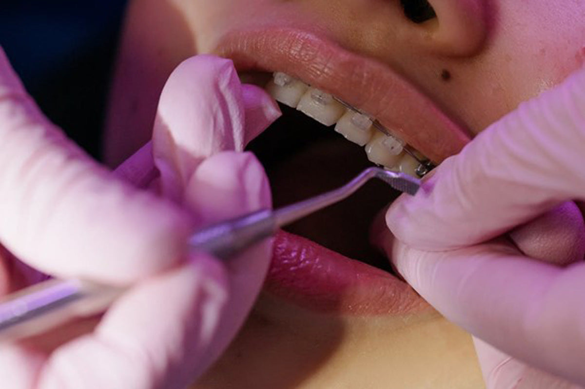 Orthodontic treatment for teeth alignment