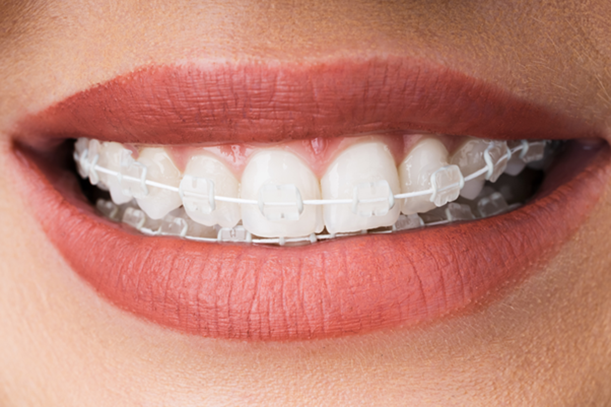 3 Ways to Fix Crooked Teeth