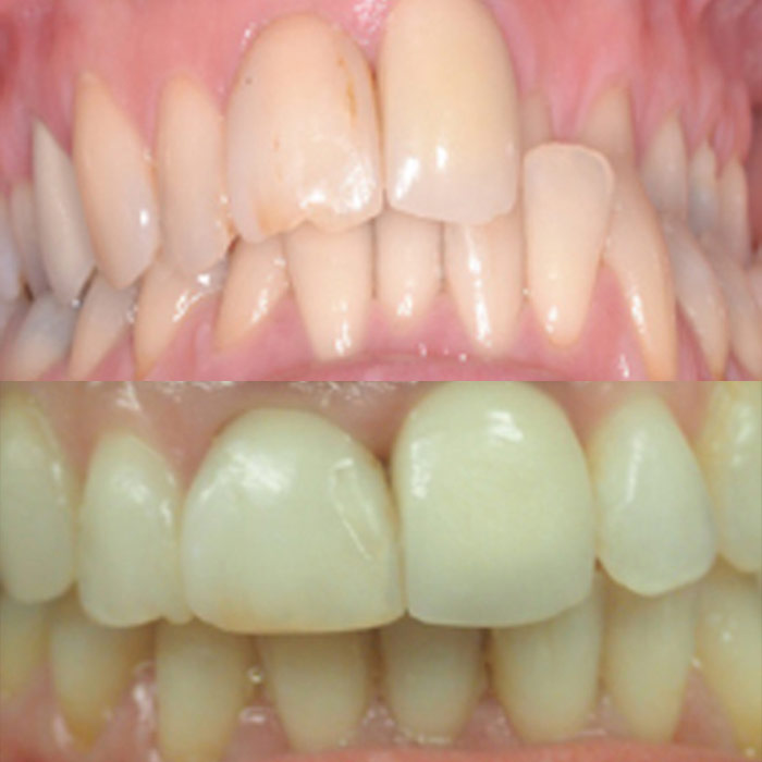 Overbite - before and after orthodontic treatment