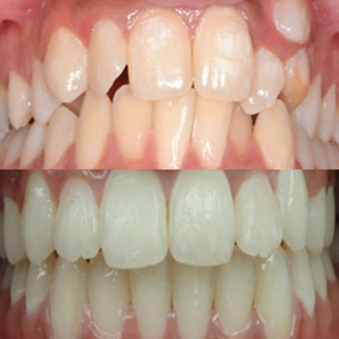 Crowded teeth - before and after orthodontic treatment