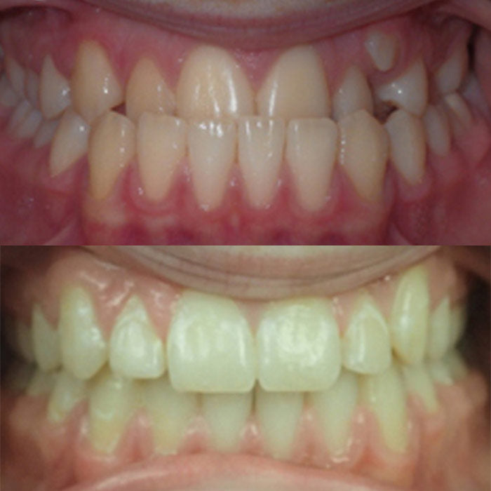 Jaw mal-alignment - before and after orthodontic treatment