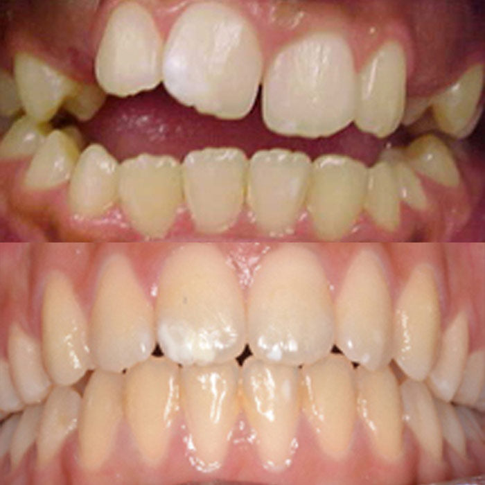 Openbite - before and after orthodontic treatment