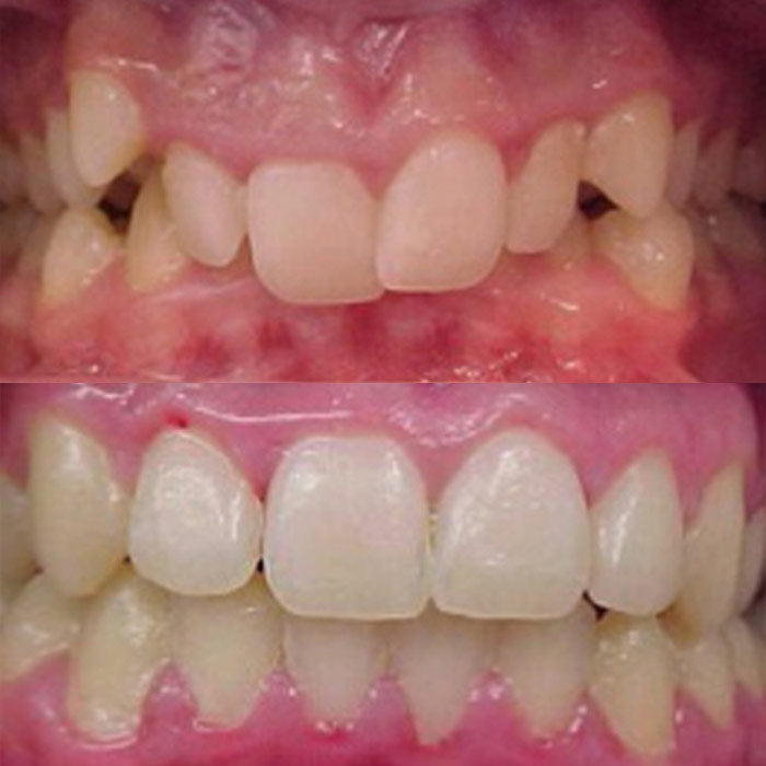 Overbite - before and after orthodontic treatment