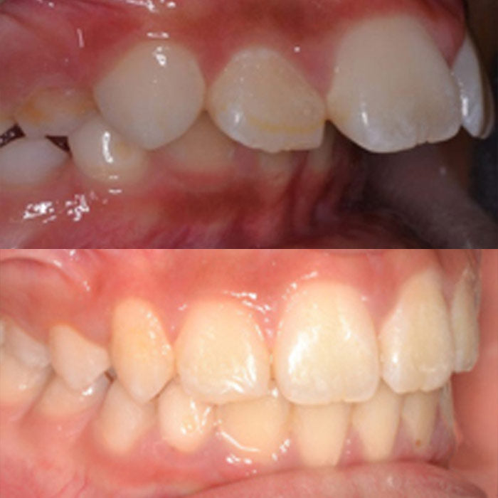 Overjet - before and after orthodontic treatment