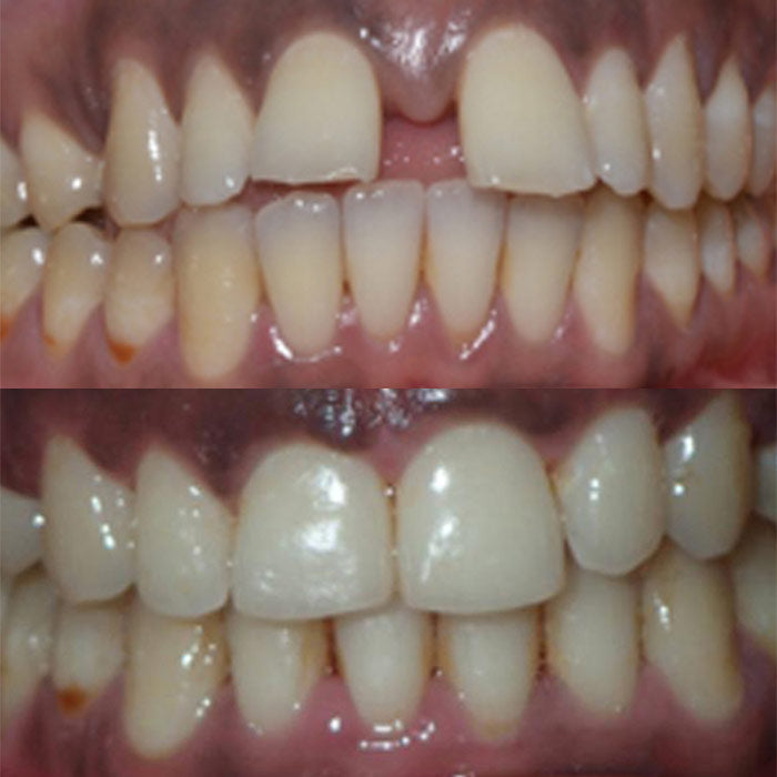 Spacing - before and after orthodontic treatment