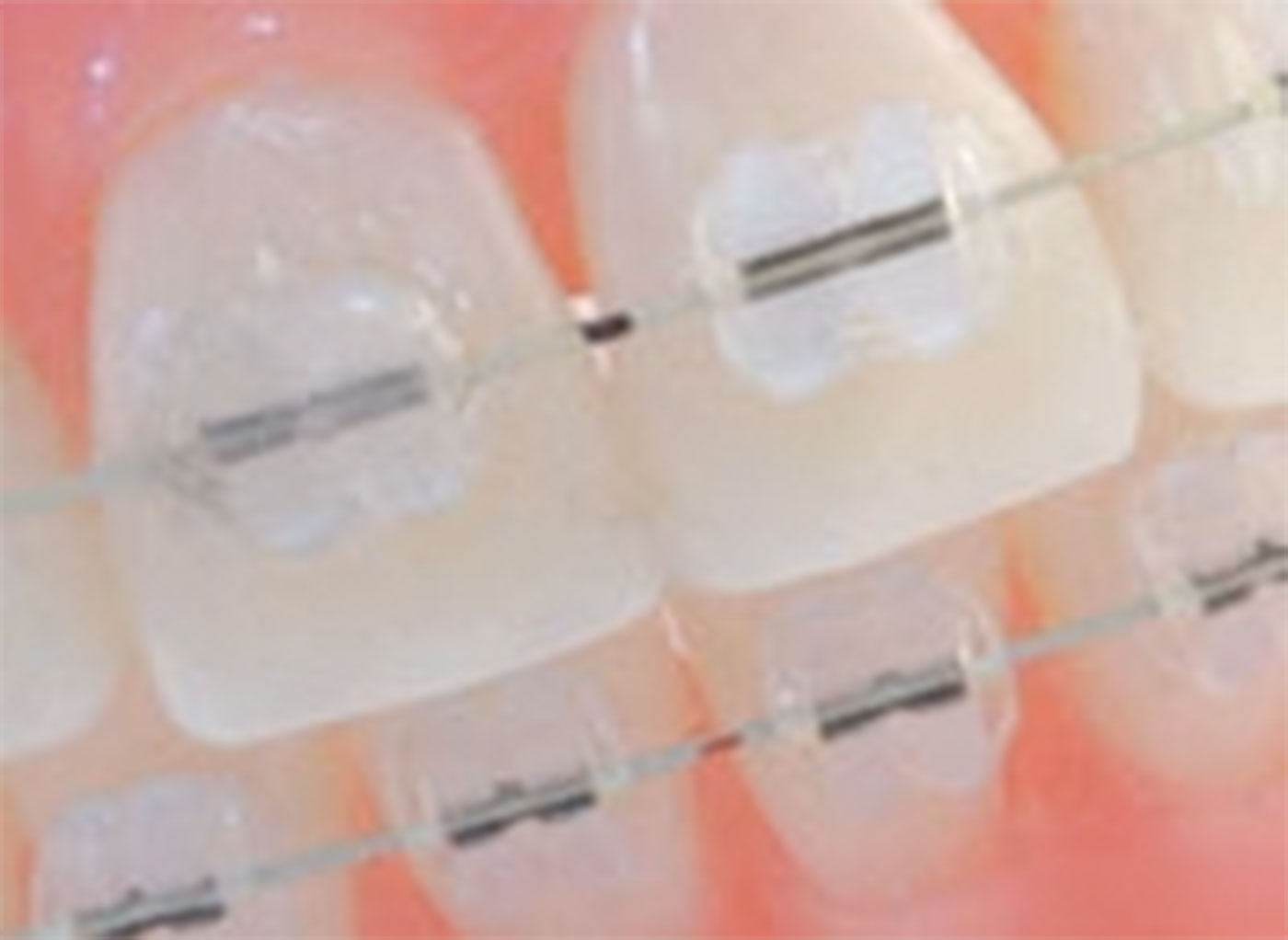 Ceramic orthodontic brackets