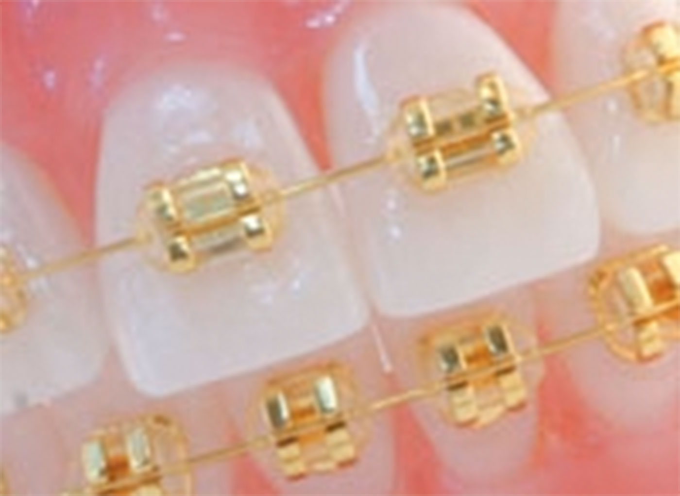 Gold orthodontic brackets