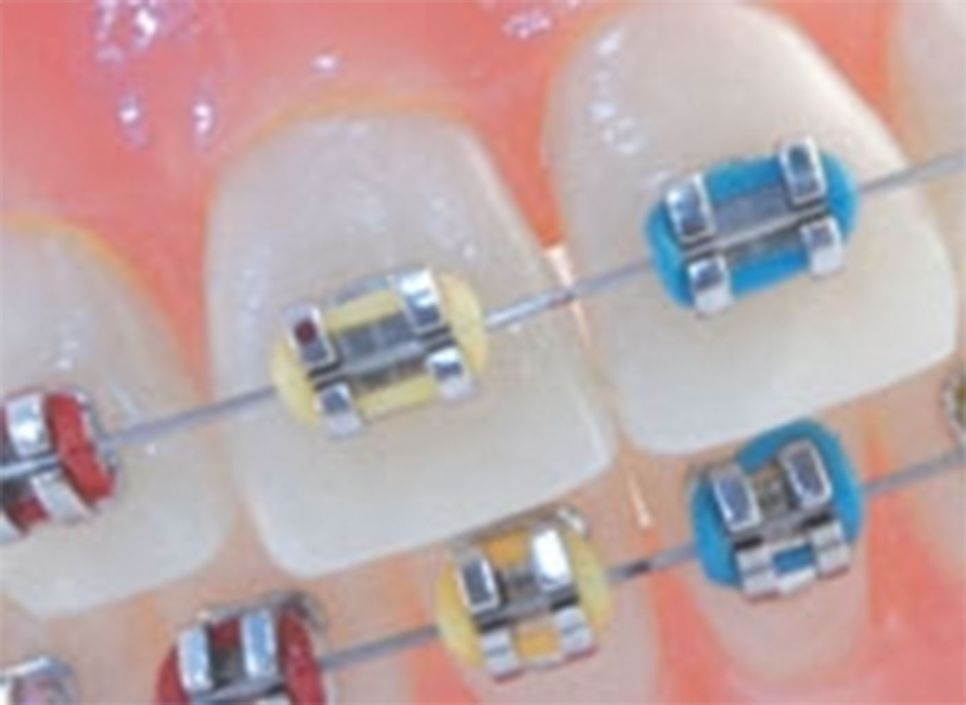 Metal orthodontic brackets with colours